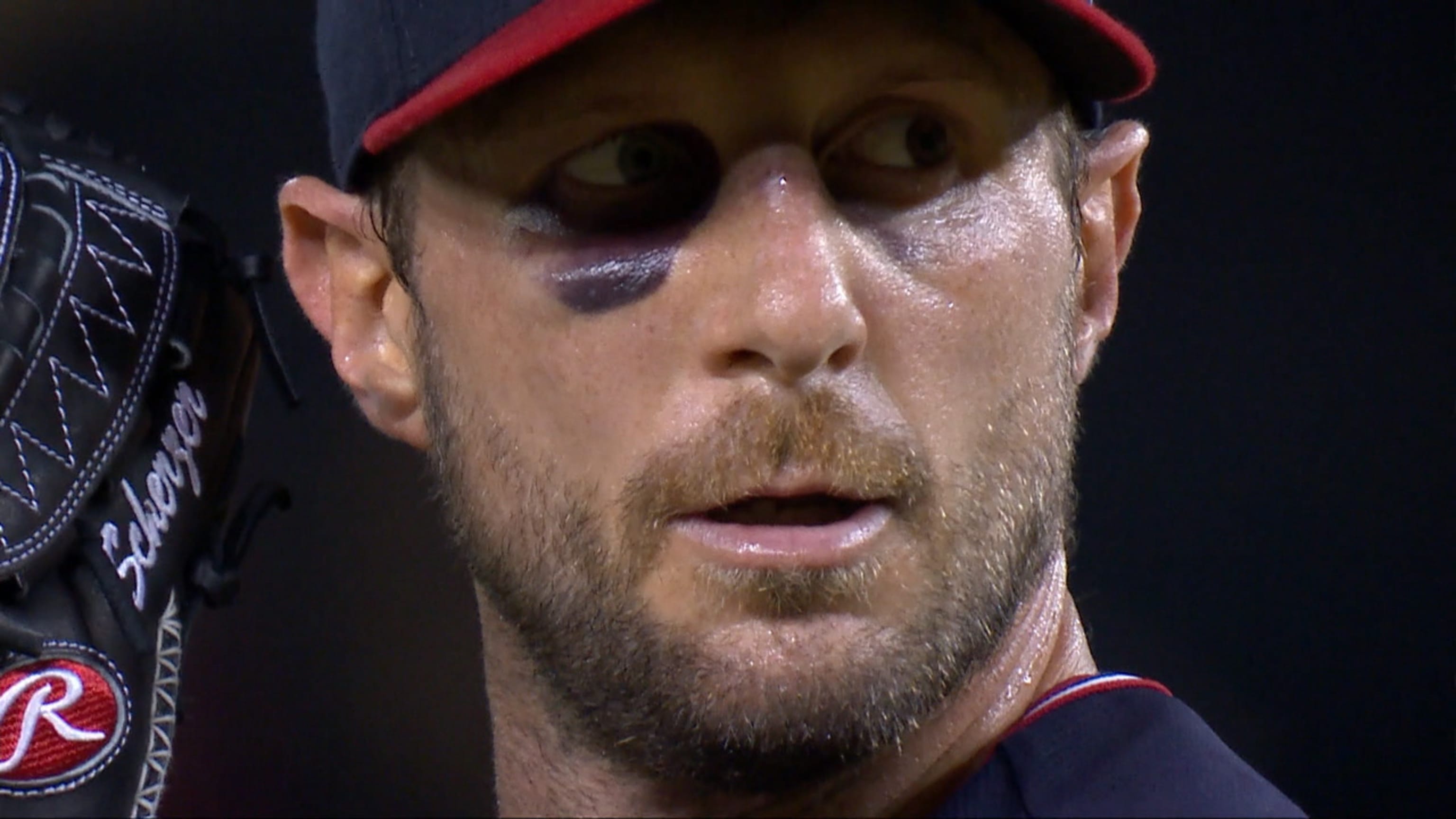 Max Scherzer pitches with broken nose and black eye