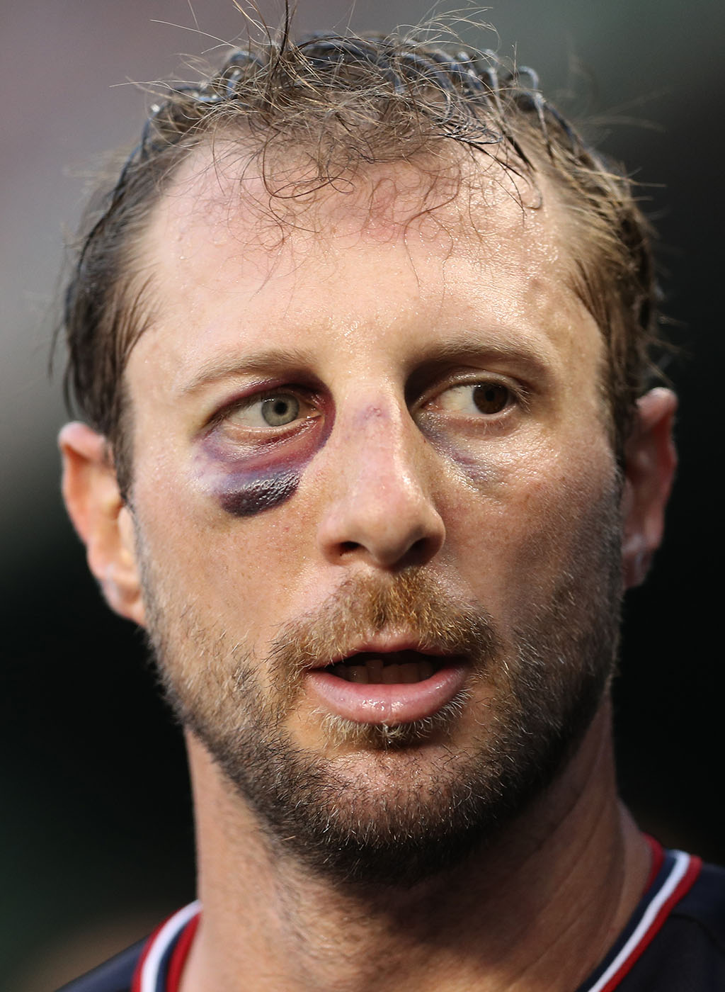 Broken nose and black eye can't stop Nationals' Max Scherzer