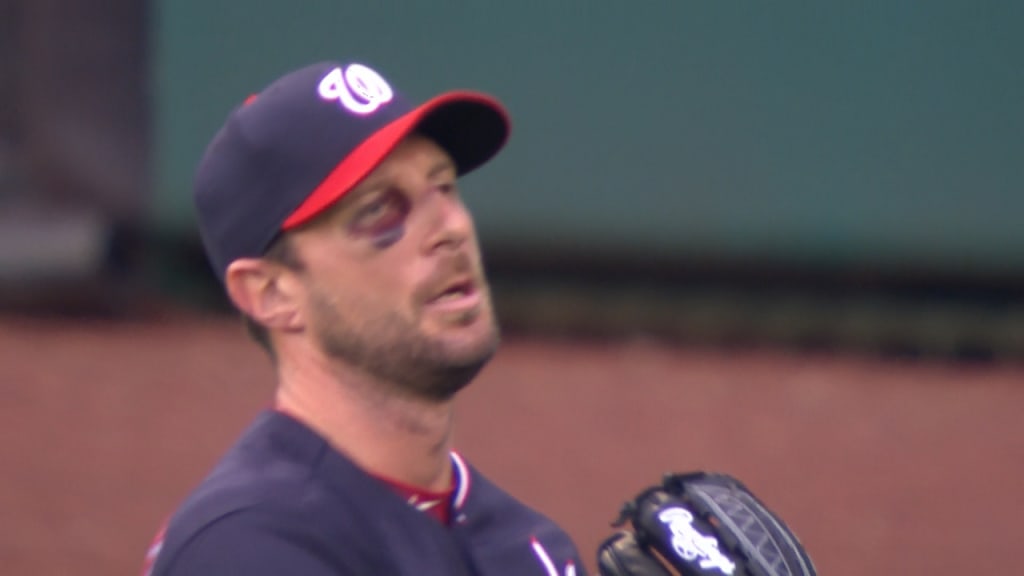 A bruise is visible below Washington Nationals starting pitcher Max  Scherzer's right eye as he stands in the dugout in the seventh inning of  the second baseball game of a doubleheader against