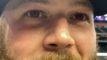 Jake Burger's red contacts for his eyes