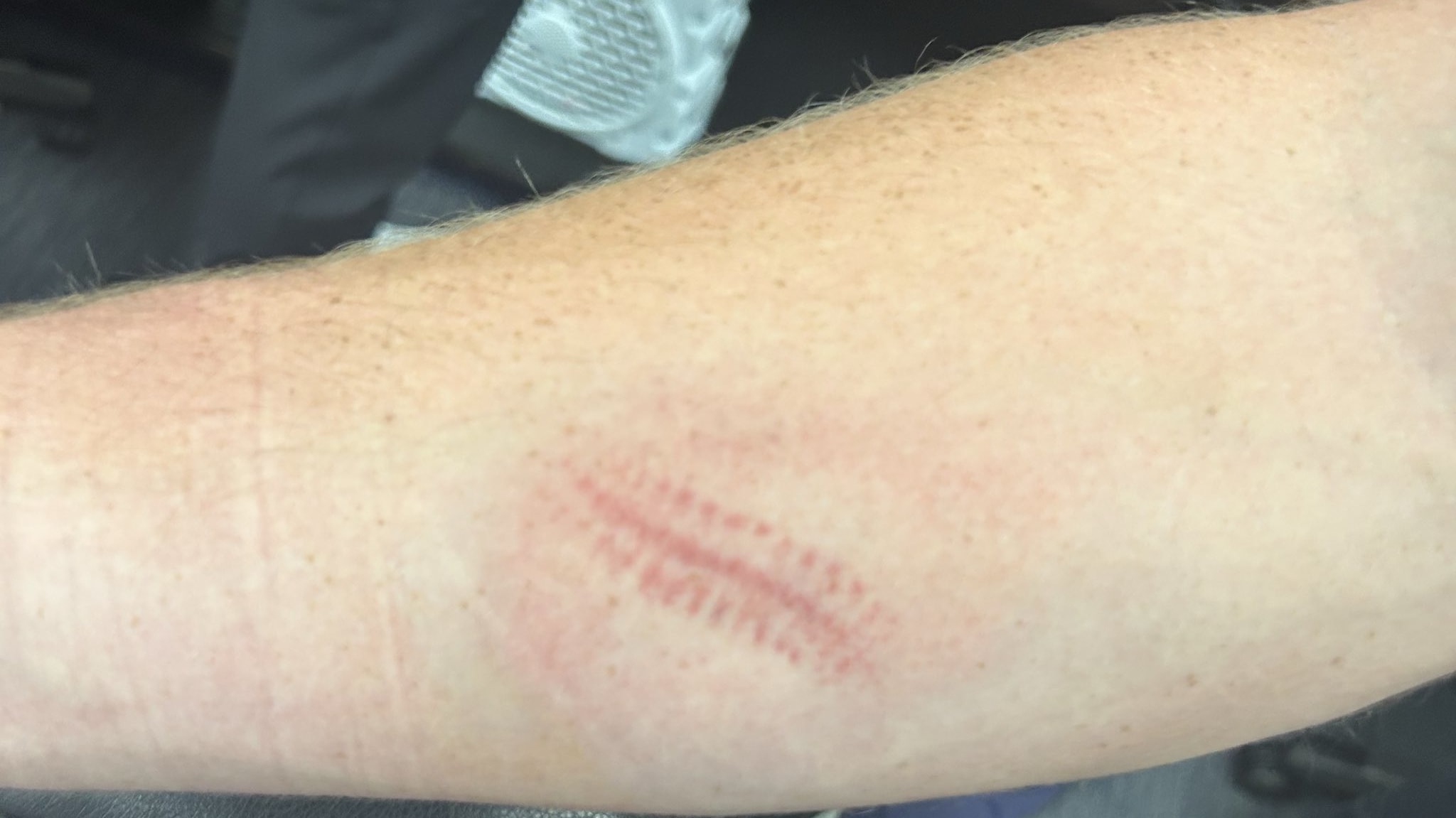 Baseball seams left an imprint on Travis Bazzana's forearm