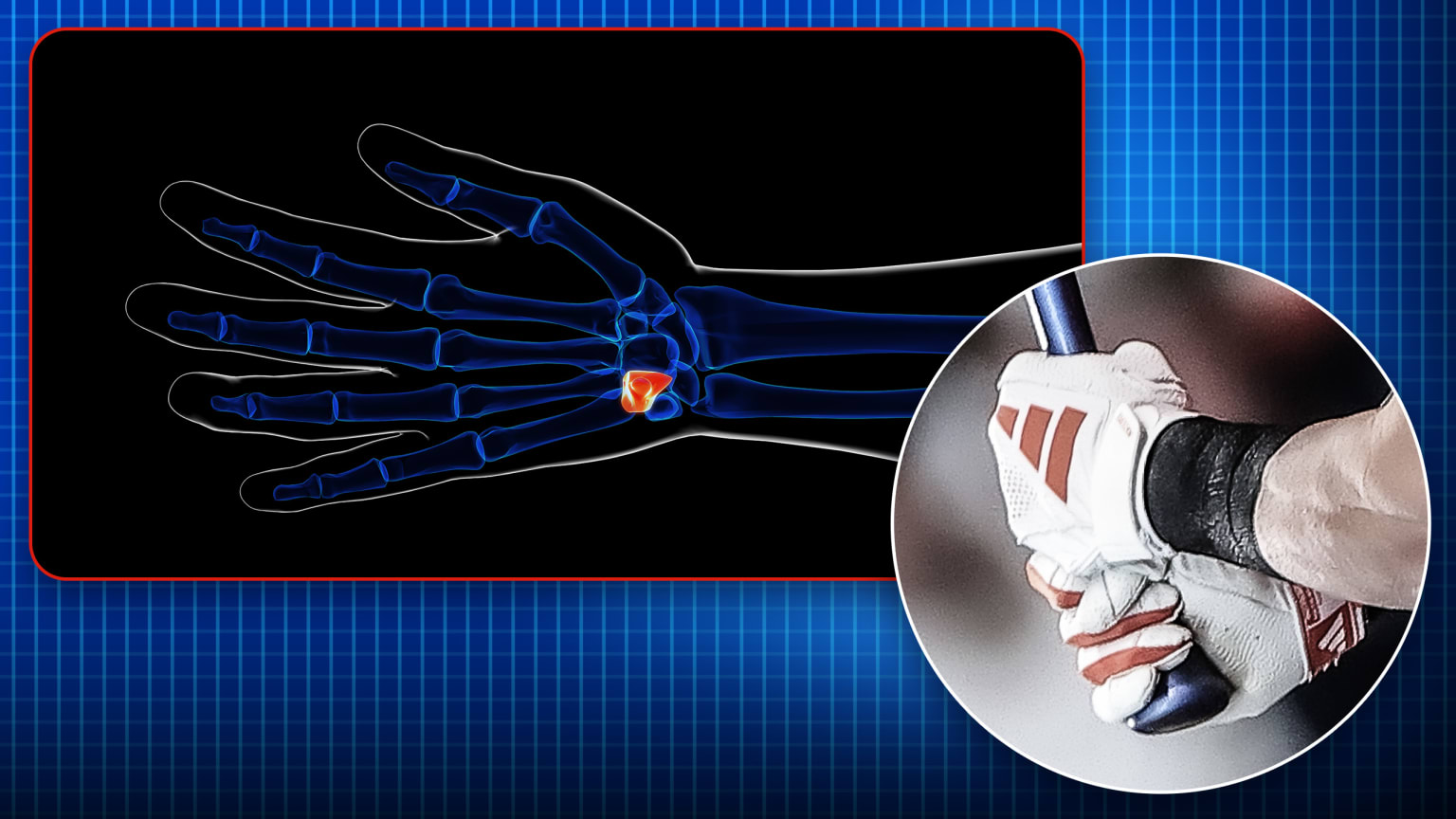 [分享] 鉤骨是什麼？為什麼這麼多球員都傷到了它 - 棒球 - PTT.BEST 批踢踢爆文